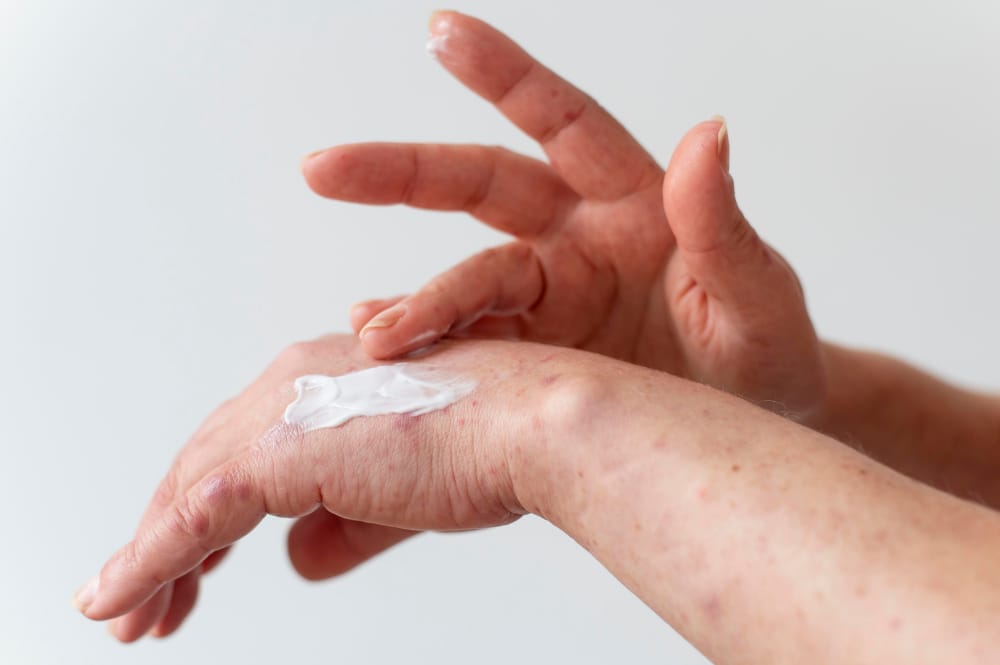 dermatita seboreică
