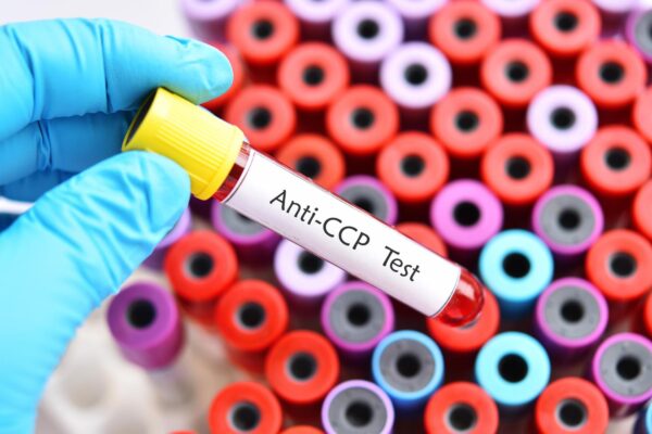 Anticorpi anti-CCP: ce rol au în diagnosticul artritei