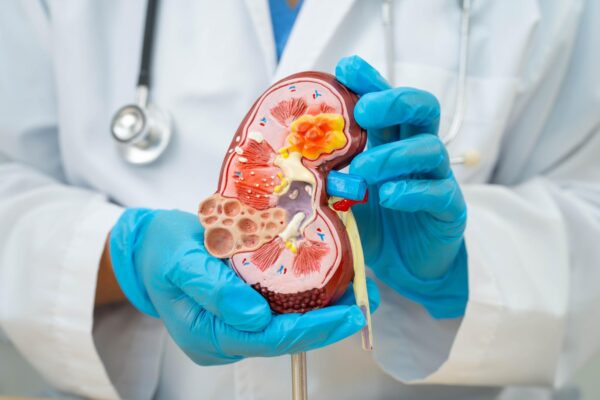 Cancer renal: ce înseamnă o formațiune descoperită întâmplător