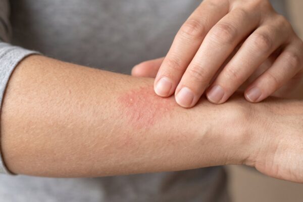 Urticarie care durează de săptămâni: de ce nu este întotdeauna o alergie alimentară