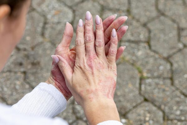 Dermatită atopică la adult: cum se recunosc puseele